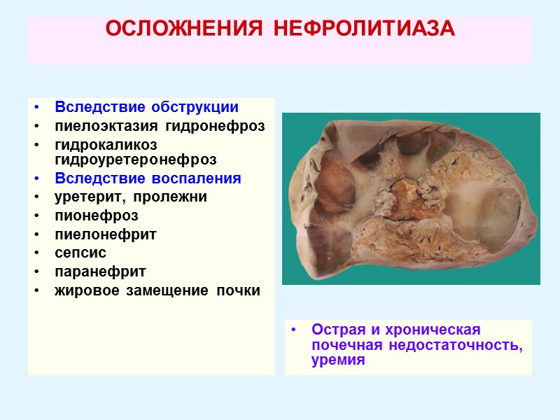 ОСЛОЖНЕНИЯ НЕФРОЛИТИАЗА  Вследствие обструкции пиелоэктазия гидронефроз гидрокаликоз  гидроуретеронефроз  Вследствие воспаления уретерит,